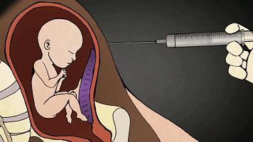 流产和宫外孕哪个可怕,流产跟怀孕有什么关系