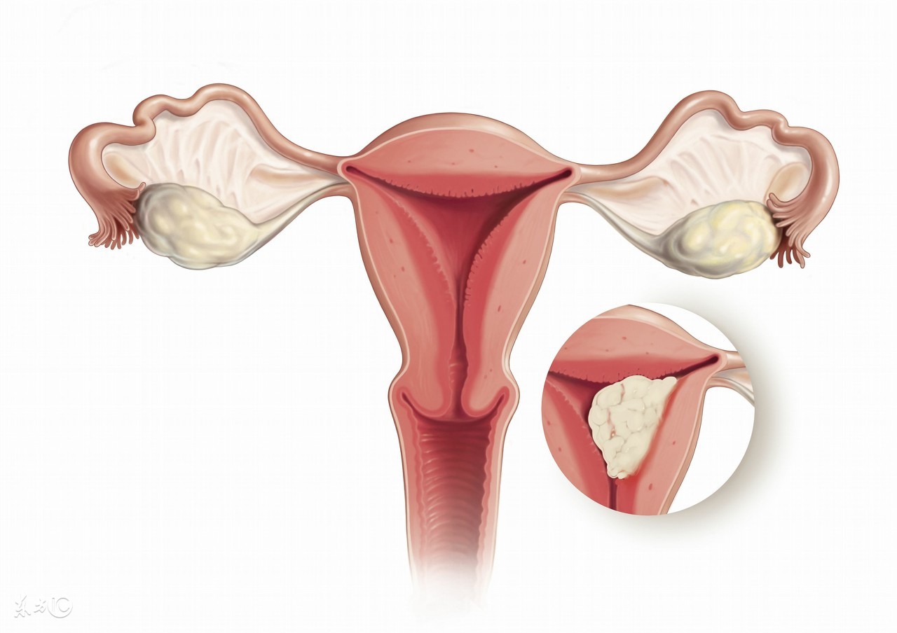 子宫肌瘤24*28需手术治疗吗,子宫肌瘤切割手术需要多少钱