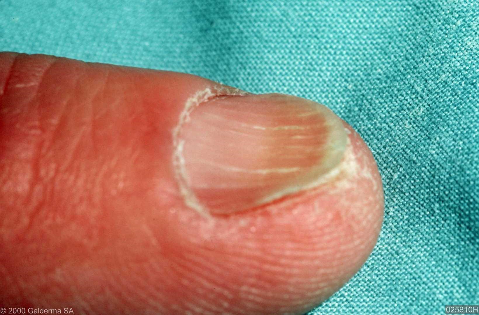 凹陷指甲修复,凹指甲是什么原因