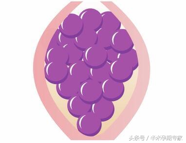 什么是葡萄胎b超能查出来吗,什么是葡萄胎