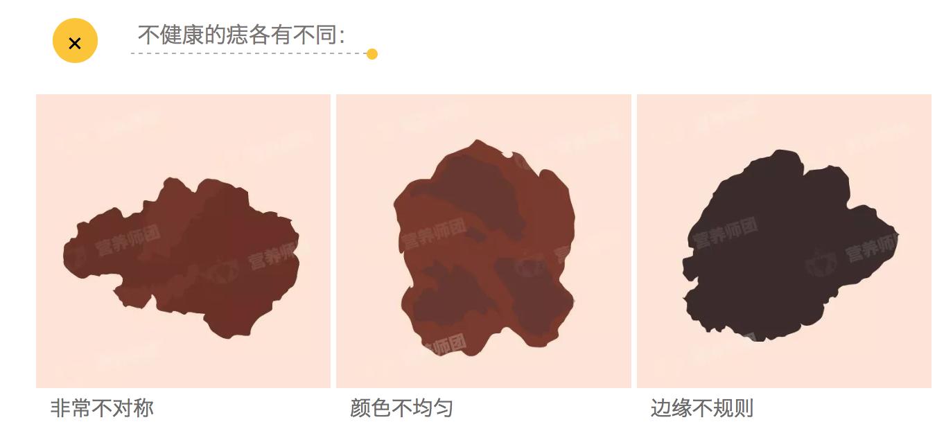 痣总是掉皮,痣发黑不规则