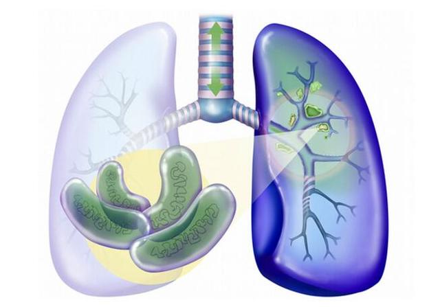 以前得过肺结核是陈旧性肺结核吗,以前得过肺结核现在会被传染吗