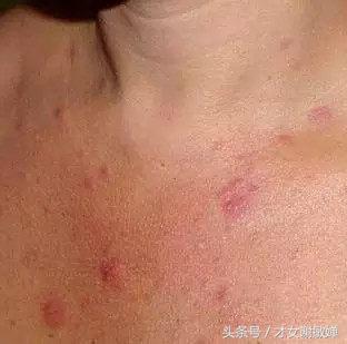 护肤处理闭合粉刺,谢敏婵的护肤品