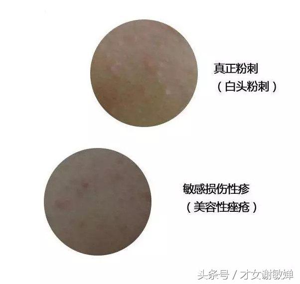 护肤处理闭合粉刺,谢敏婵的护肤品