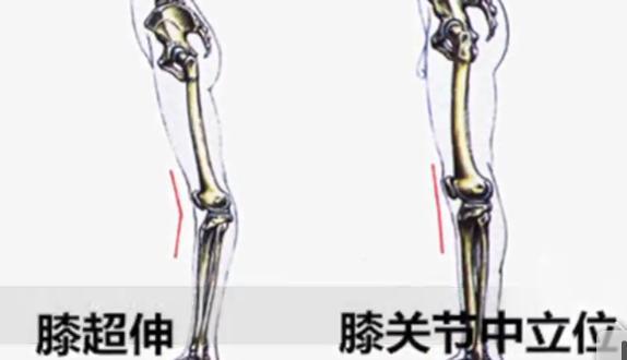 膝盖过伸如何矫正锻炼的图解,膝盖超伸怎么矫正腿型