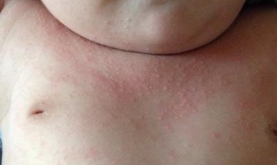 婴儿脸上疹子,婴儿疹子