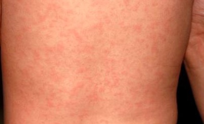 婴儿脸上疹子,婴儿疹子