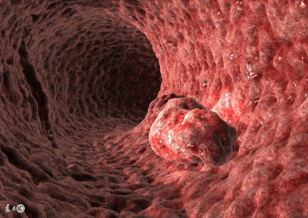 直肠癌被误诊为痔疮赔多少,肠镜会不会将直肠癌和痔疮误诊