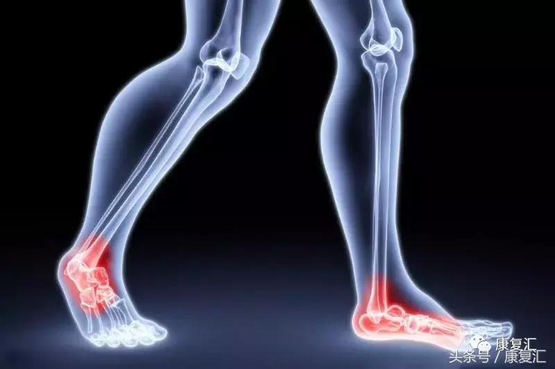 踝关节扭伤正确处理方法是,董氏奇穴治疗踝关节扭伤