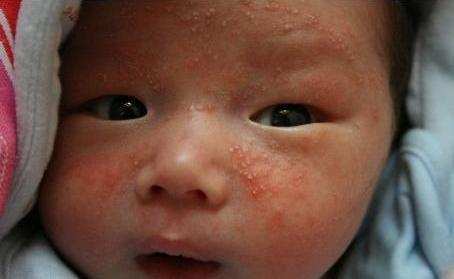 宝宝肤专家可以治疗湿疹吗,一岁半宝宝湿疹怎么治疗