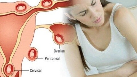 子宫损伤会更容易宫外孕吗,准妈妈们如何预防宫外孕