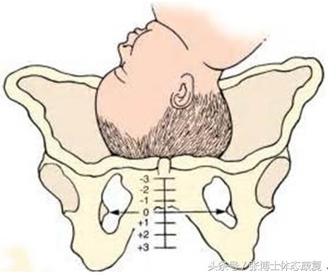 孕期耻骨痛怎么训练恢复,孕期耻骨疼怎么锻炼