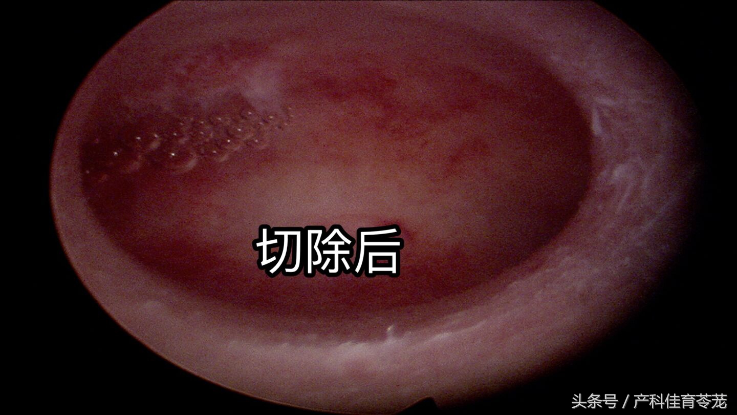 子宫腔长了息肉，哪些情况需要手术