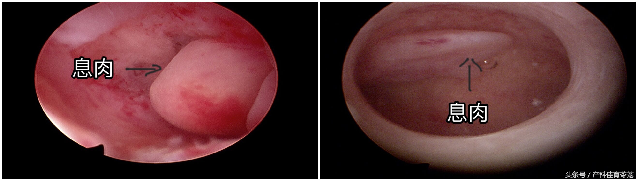 子宫腔长了息肉，哪些情况需要手术