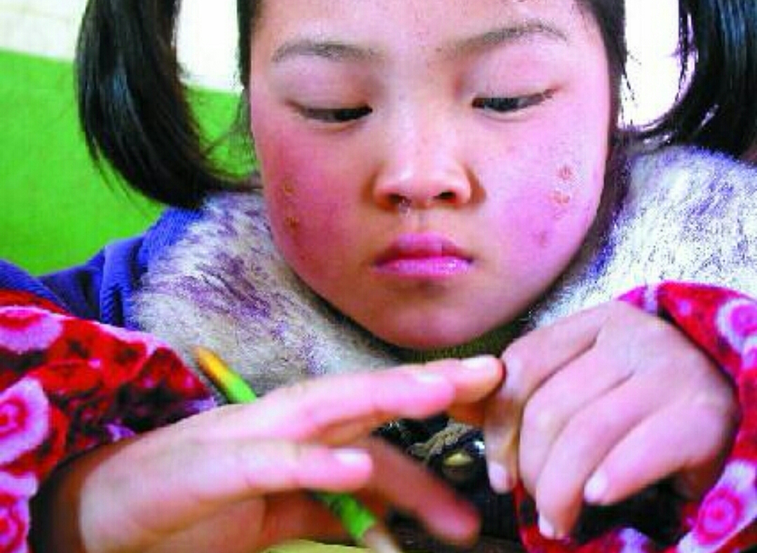 冻伤疮最佳治疗方案,冻伤疮什么意思