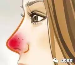 酒渣鼻就是玫瑰痤疮吗,酒渣鼻是脂溢性皮炎吗