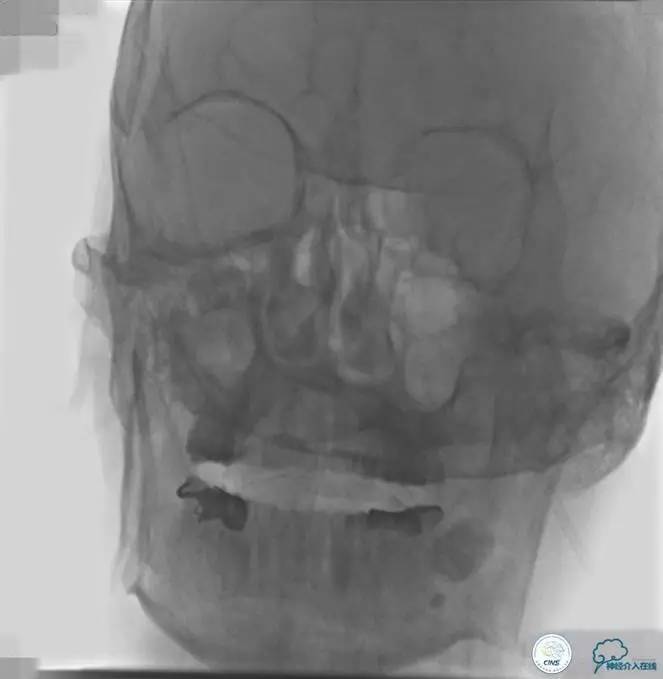 急性缺血性卒中静脉溶栓2018指南,急性缺血性卒中血管内再通标准