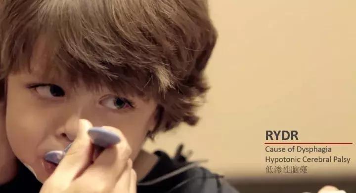 儿童吞咽障碍的护理诊断,儿童吞咽知识小科普