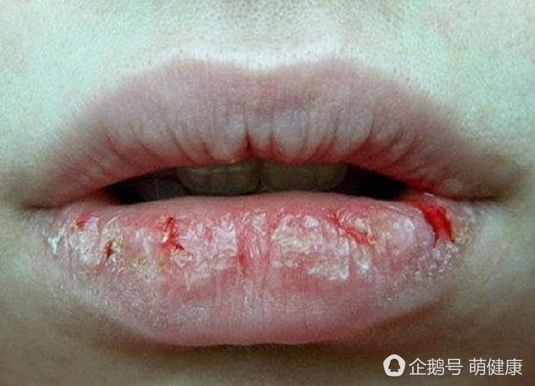 嘴唇干裂用什么小妙招,嘴唇干裂怎么办这些小妙招别错过