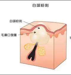 脸上小疙瘩消除最快方法,脸上小疙瘩密密麻麻怎么治疗