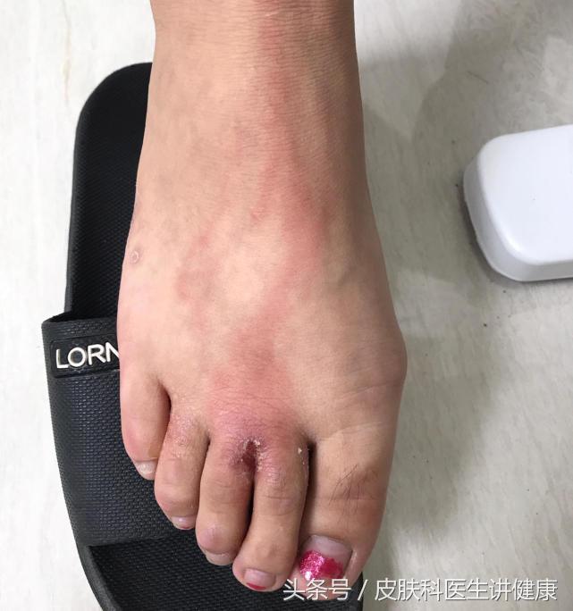 脚气引起的丹毒有什么最佳疗法,脚气感染丹毒怎么办