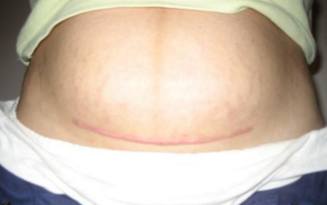 女人剖腹产两年疤痕痒痒,剖腹产20天后刀口疤痕发红发痒