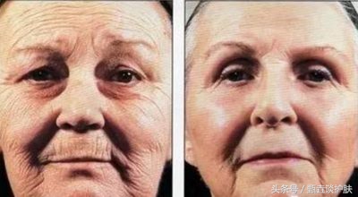 怎样防止衰老去皱纹,怎样防止皮肤老化皱纹