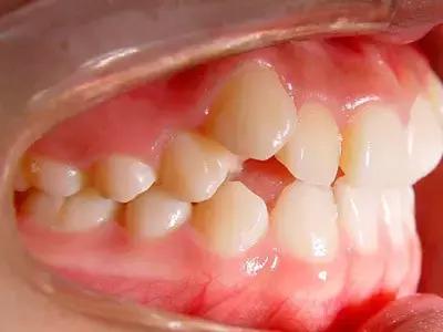 人为什么会少长牙,为什么会有虎牙齿