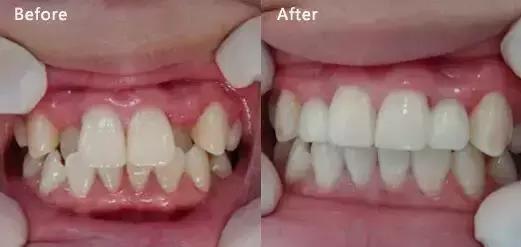 人为什么会少长牙,为什么会有虎牙齿