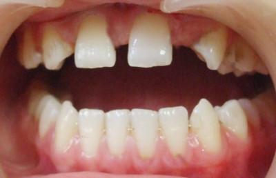 牙疼牙齿脱落怎么回事,牙痛牙裂缝怎么治好