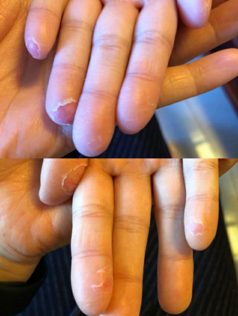 猩红热颜色,猩红热又开始了吗