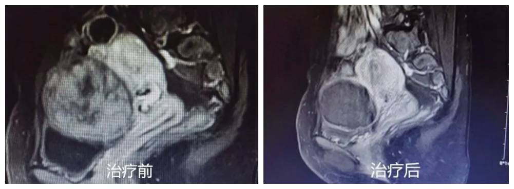 柳州一女子痛经10年,便秘3个月!一检查不得了!可别忽视了这些……