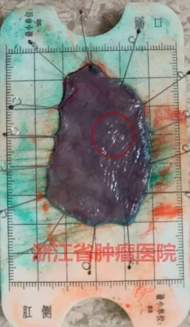 食管大面积黏膜病变，看看这家医院如何处理？！