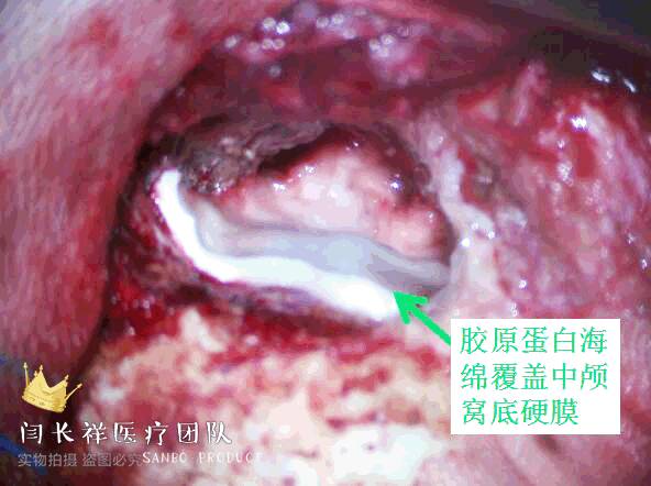 烦人的耳鸣,烦人耳鸣