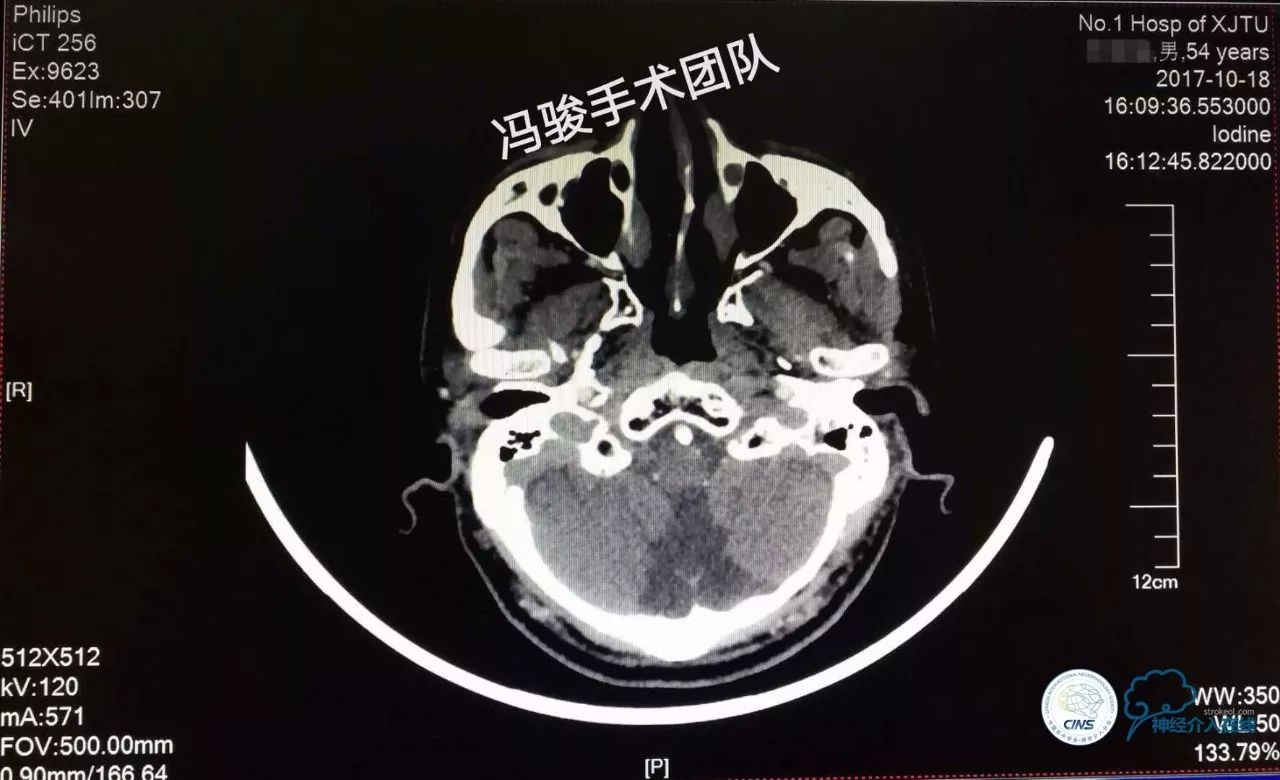 天新福—百家百言｜一例孤独椎动脉V4段并PICA重度狭窄支架手术及1年随访