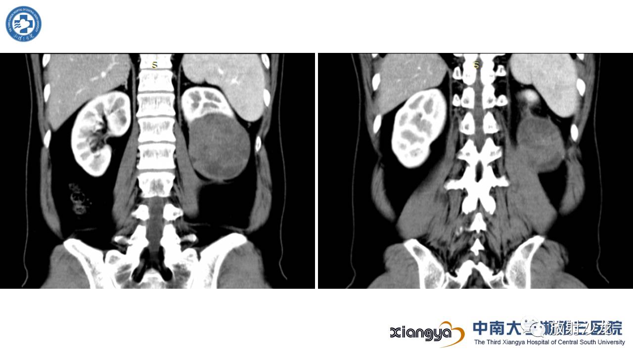 「每日一例｜489例」男，左侧腰部撞伤后疼痛3月