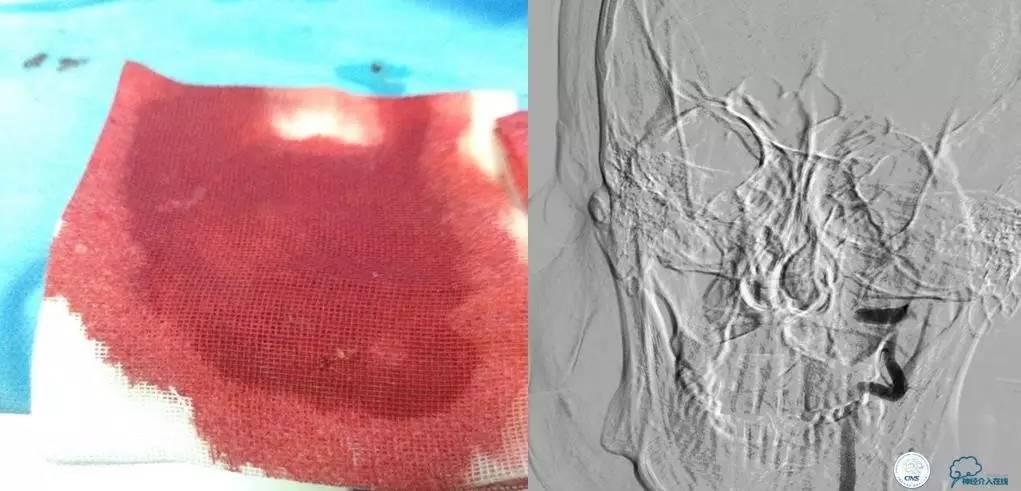 急性缺血性卒中静脉溶栓2018指南,急性缺血性卒中血管内再通标准