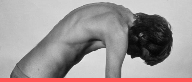 强直性脊柱炎是什么病症,跟强直性脊柱炎很像的病