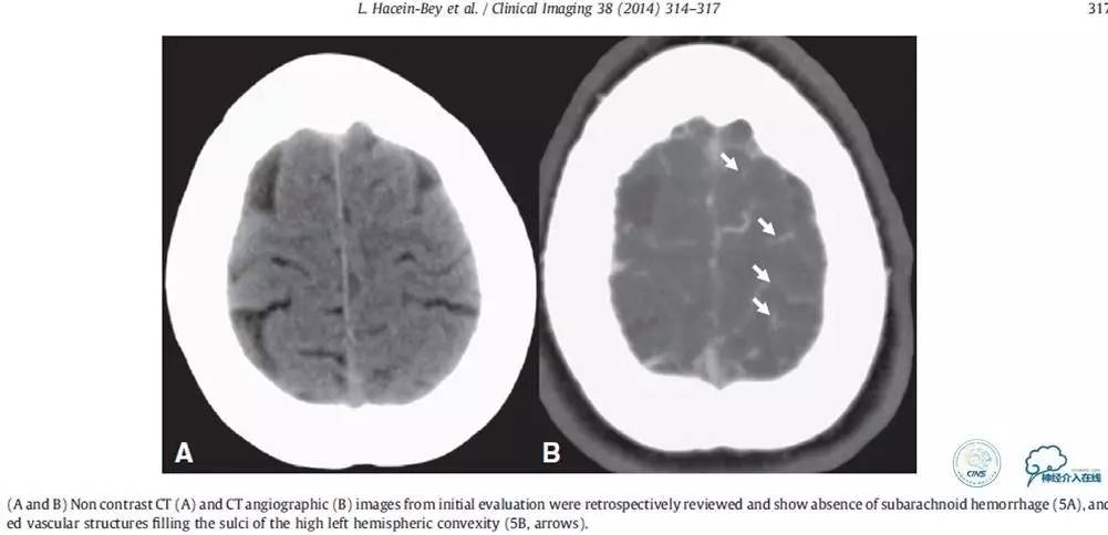 急性缺血性卒中静脉溶栓2018指南,急性缺血性卒中血管内再通标准