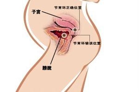 备孕取环前后注意事项怎么做,取完环二胎备孕的正式方法