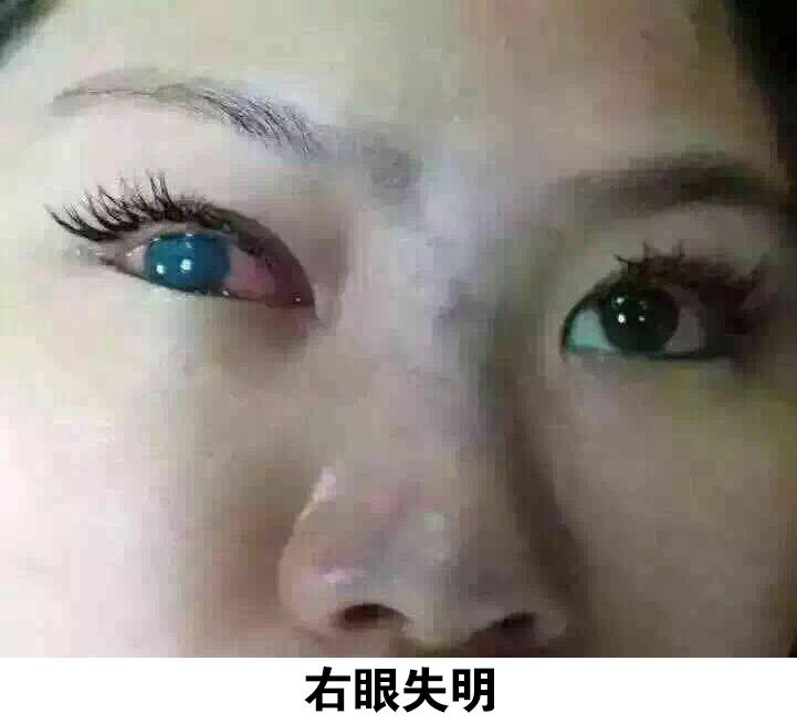 注射隆鼻的危险,注射隆鼻眼瞎