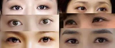 哭多会成为双眼皮？变双眼皮的招数多着呢