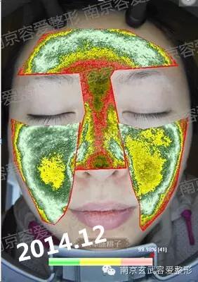 手把手教你如何抗痘,教你有效抗痘6个绝招