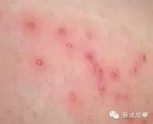 教你对付湿疹,别让湿疹误了宝宝颜值