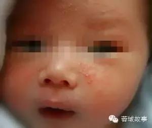 湿疹痒痒如何缓解,湿疹痒痒处能拍打么