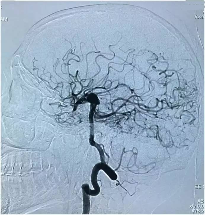 基底动脉顶端动脉瘤加左侧小脑上动脉瘤以Y型支架结合弹簧圈栓塞