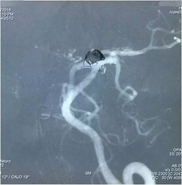基底动脉顶端动脉瘤加左侧小脑上动脉瘤以Y型支架结合弹簧圈栓塞