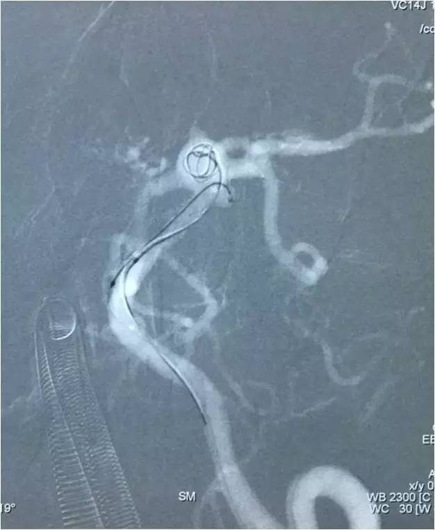 基底动脉顶端动脉瘤加左侧小脑上动脉瘤以Y型支架结合弹簧圈栓塞
