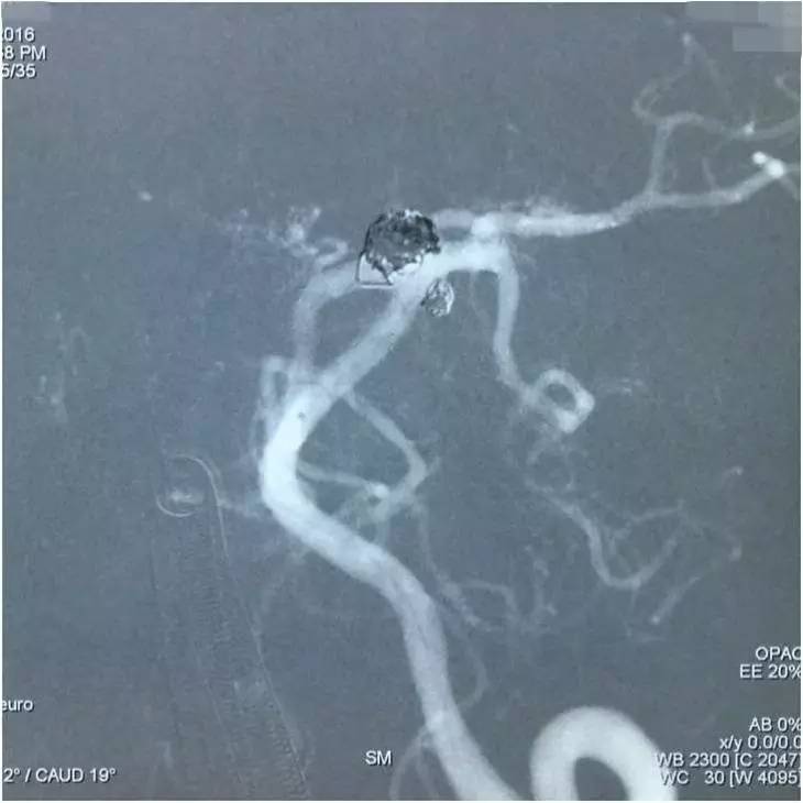 基底动脉顶端动脉瘤加左侧小脑上动脉瘤以Y型支架结合弹簧圈栓塞