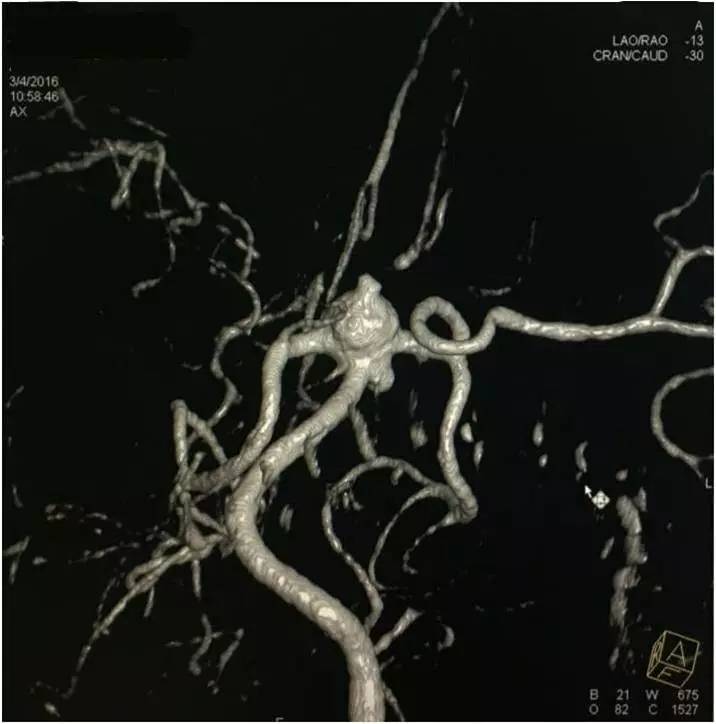 基底动脉顶端动脉瘤加左侧小脑上动脉瘤以Y型支架结合弹簧圈栓塞